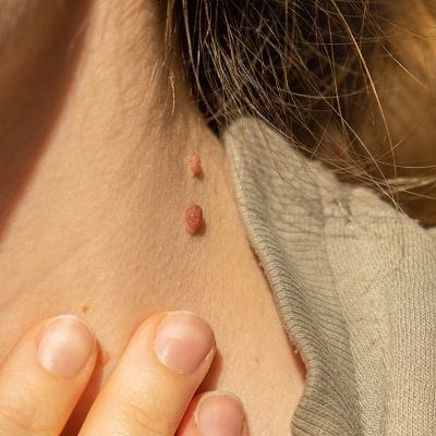What Areas Of The Body Can Have Skin Tags Removed? by cdynmic