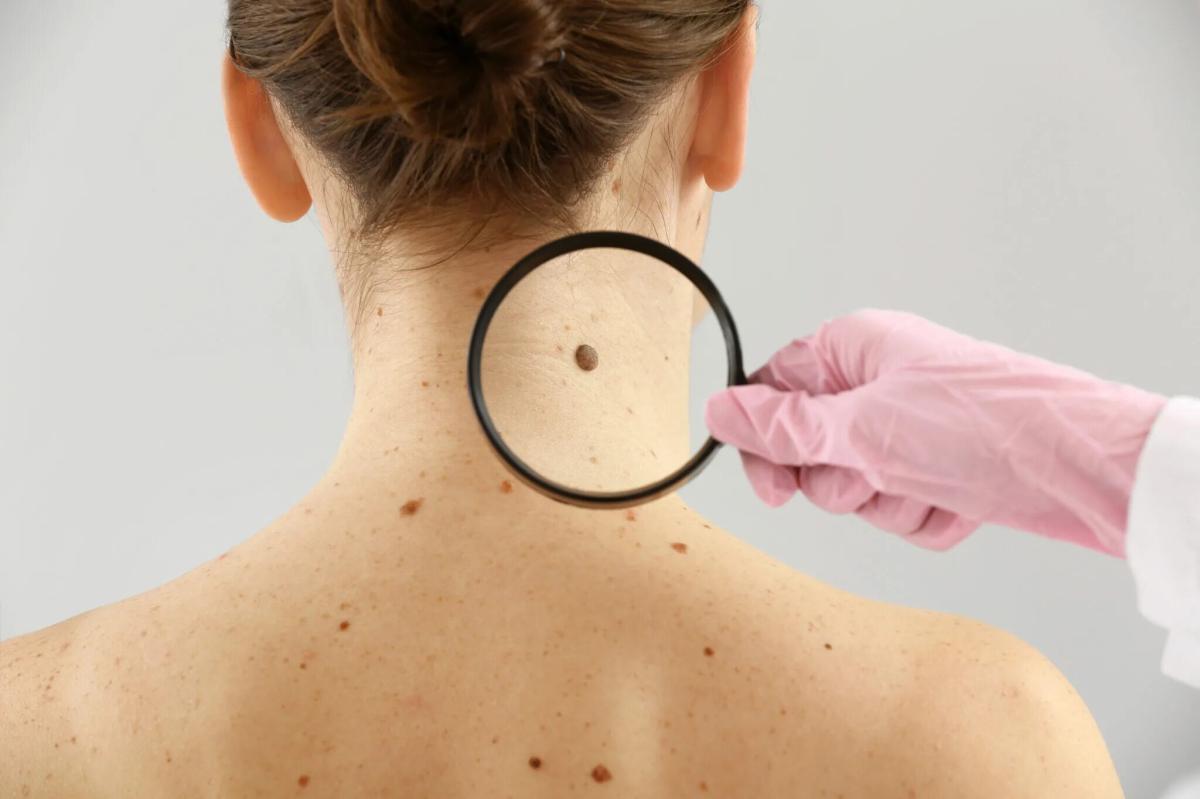 Does Moles Removal Prevent Future Skin Irregularities? by dynamiclifeclinics