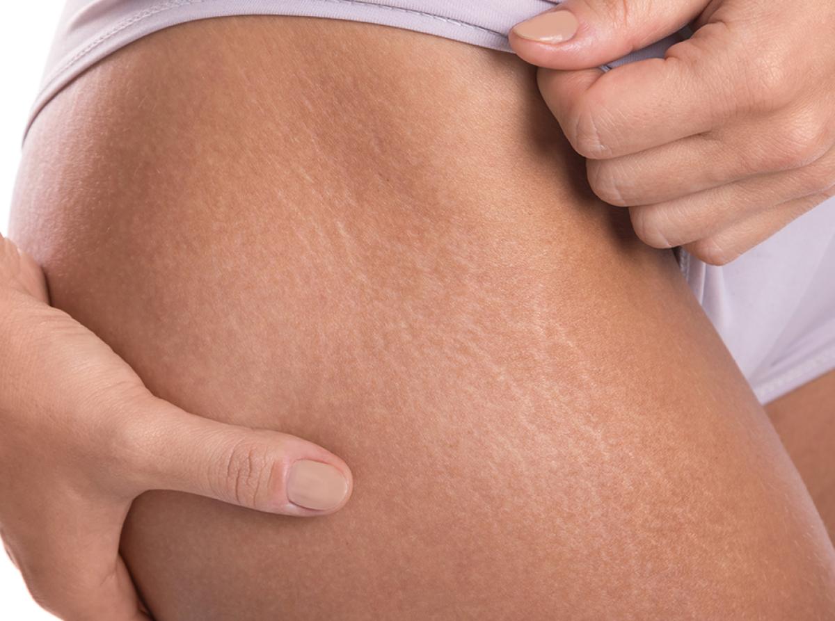 Does Laser Stretch Marks Removal Work On Old Marks? Does Laser Stretch Marks Removal Work On Old Marks? by MuhammadAhmad