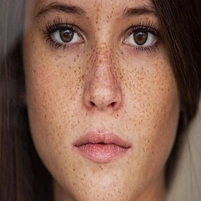 Is Laser Treatment Effective For Freckles And Blemishes? by dynamicaesthetic