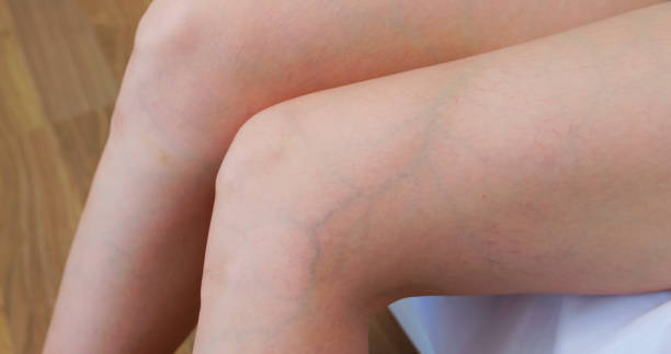 Does Varicose Veins Treatment Help With Tired Legs? by Enfieldabudhabi