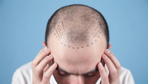 Can FUE Hair Transplant Fix Receding Hairlines? by Enfieldabudhabi