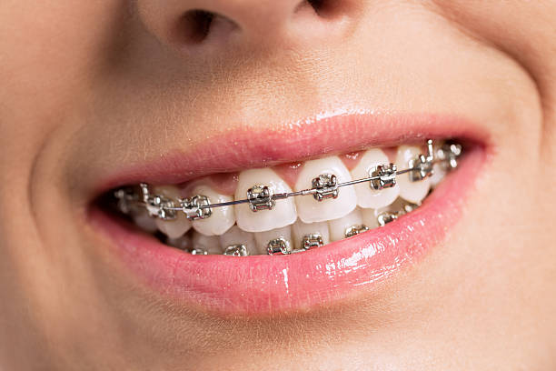 How To Care For Dental Braces For A Great Experience How To Care For Dental Braces For A Great Experience by Keller & Wainwright Orthodontics