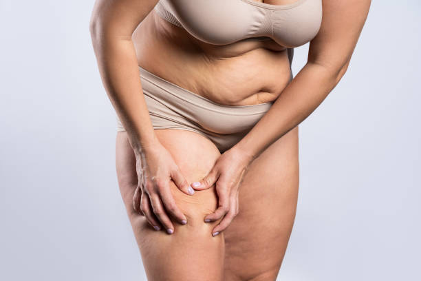 Lipedema Treatments That Actually Provide Relief by mominenfield
