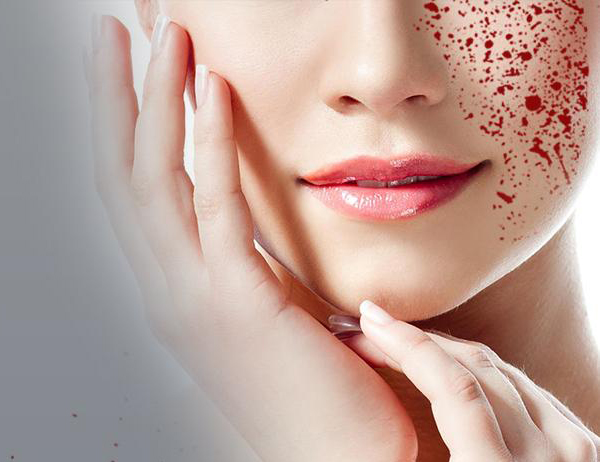 Is Vampire Facial Suitable For Sensitive Skin? by fatimadynamic