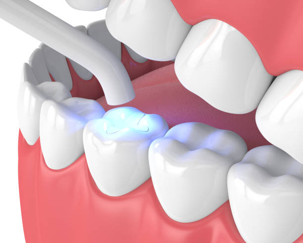 Can Dental Tooth Filling Treatment Fix Cavities Fast? by Enfieldabudhabi