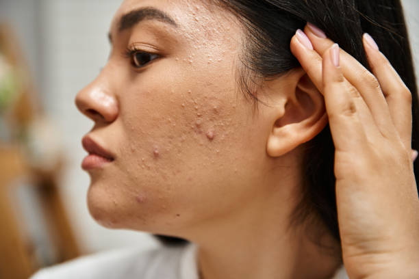 Who Is An Ideal Candidate For Laser Acne Scar Treatment ? by Enfieldabudhabi