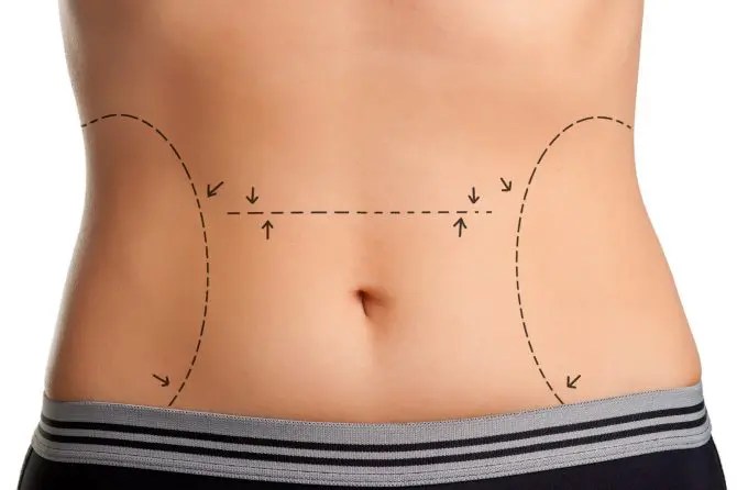 Can Men Also Benefit From A Tummy Tuck? by fatimadynamic