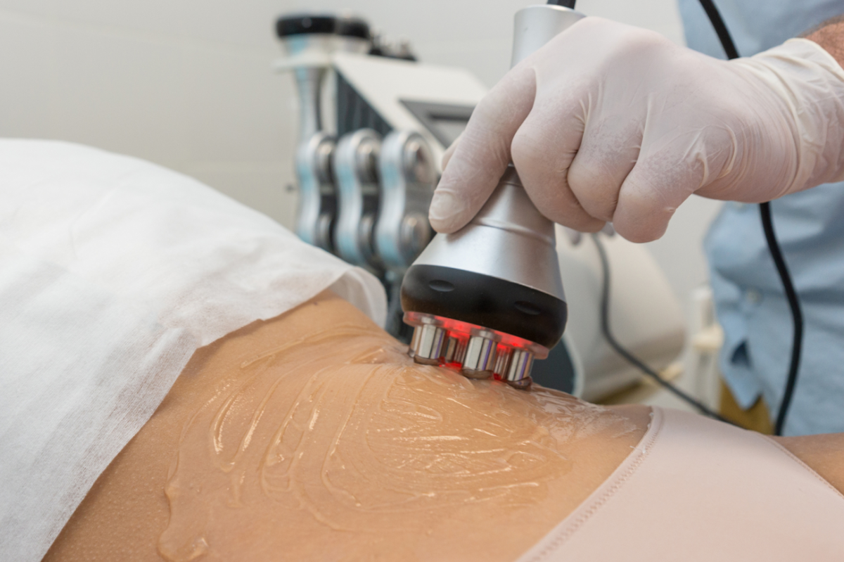 Is RF Treatment Effective For Tightening Loose Skin After Weight Loss? by dynamicaesthetic
