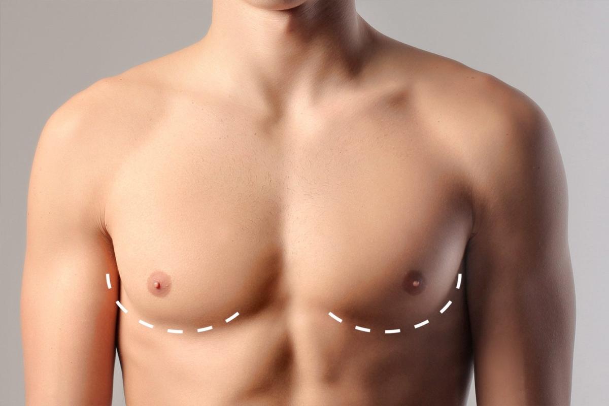How To Sustain Positive Results After Gynecomastia Surgery by enfieldroyalsaudi050
