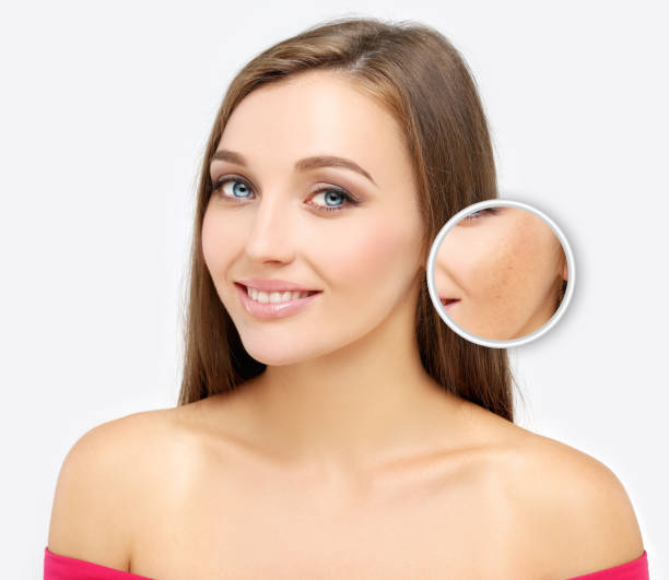 Safe Chemical Peel Practices To Minimize Skin Irritation Risks by enfieldroyalsaudi050