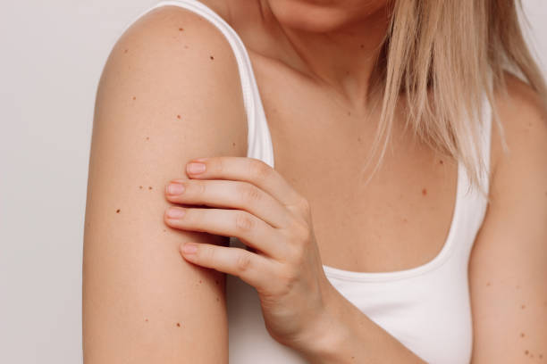 Are All Skin Moles Eligible For Mole Removal ? by Enfieldabudhabi