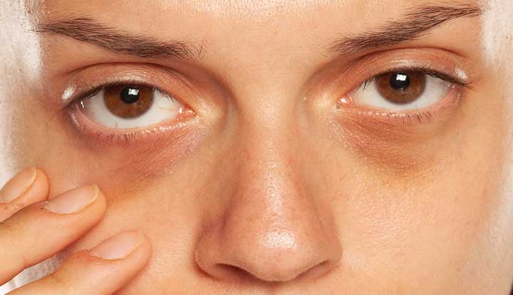 Are Dark Circles Common Across Different Skin Types? by fatimadynamic