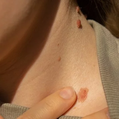 What Is The Fastest Skin Tag Removal Treatment? by dynamicaesthetic