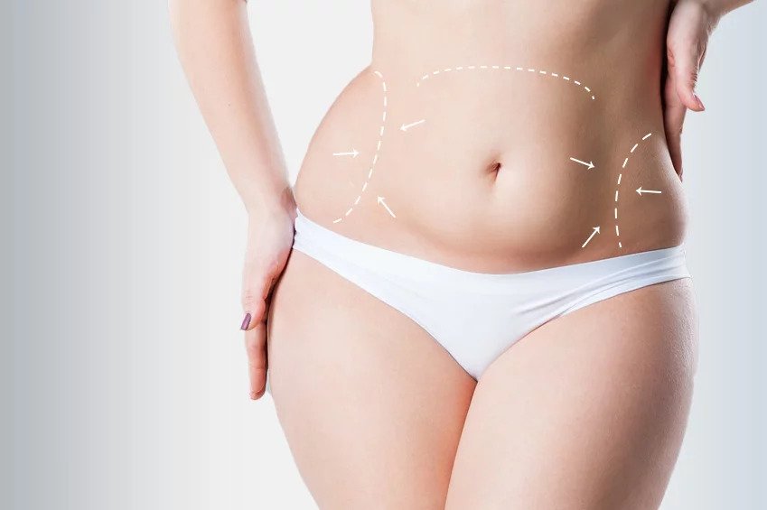 Is Liposuction Included In A Tummy Tuck? by dynamicaesthetic