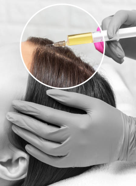 What You Need To Know Before Starting PRP Hair Treatment by enfieldroyalsaudi050