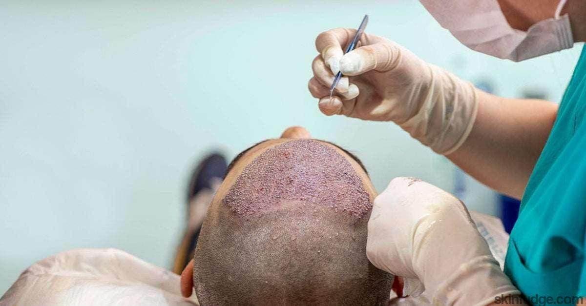 What Are The Risks Of Hair Transplant Surgery? by glamorous