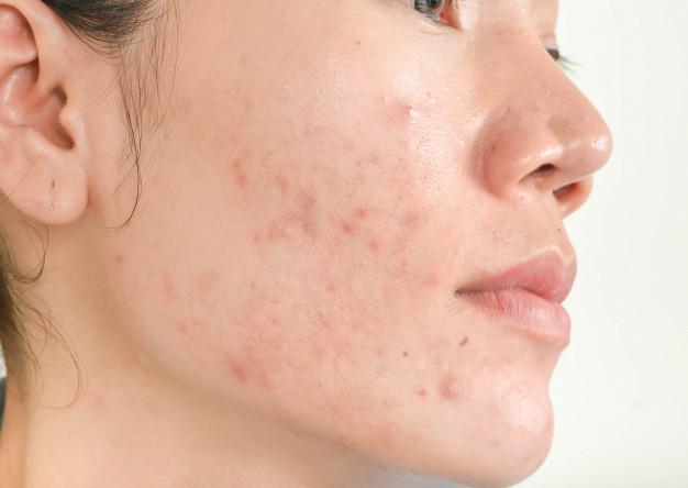 Can Dermamelan Fix Acne Scars? by fatimadynamic