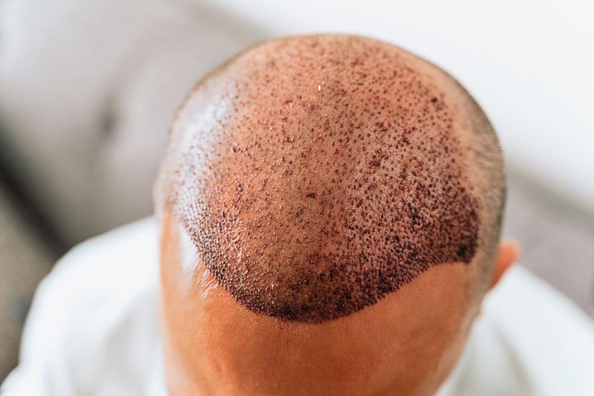 What Are The Latest Hair Transplant Technologies? What Are The Latest Hair Transplant Technologies? by eirhakhan