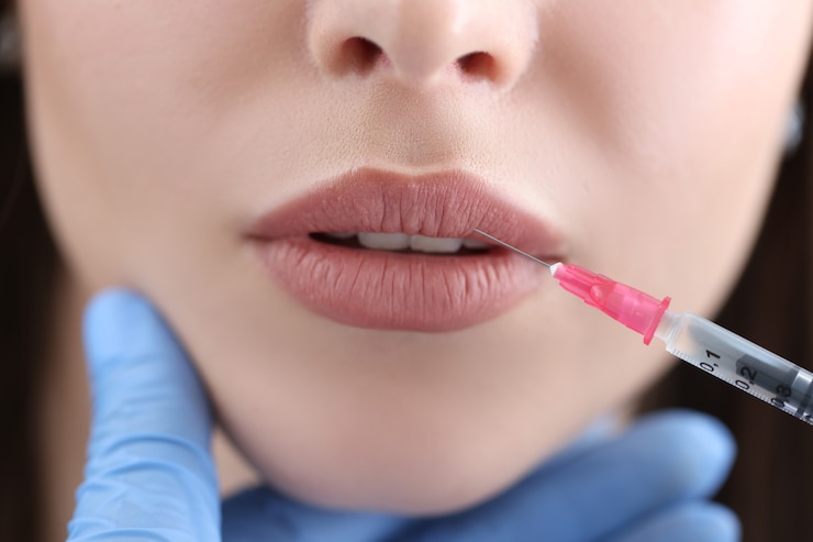What Are Russian Lip Fillers? by dynamicaesthetic