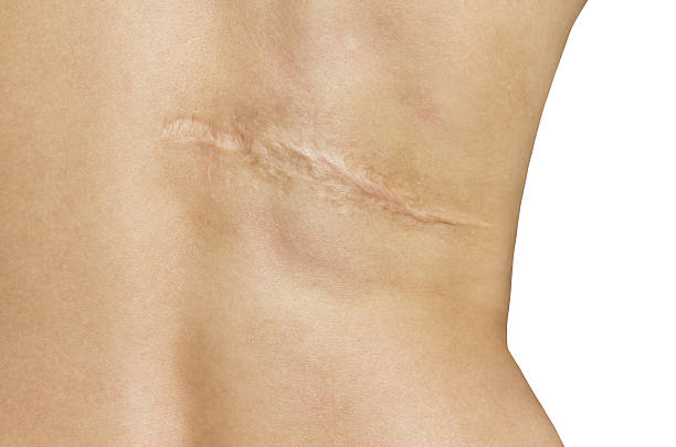 How Many Sessions Are Needed For Post Surgical Scars Treatment ? by Enfieldabudhabi