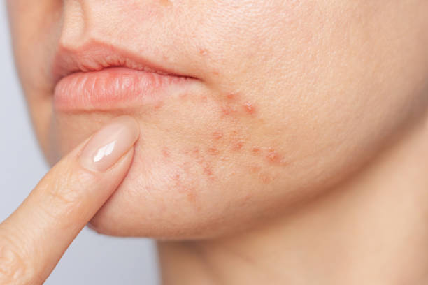 Can Acne Scar Treatment Remove Old Stubborn Scars? by Enfieldabudhabi