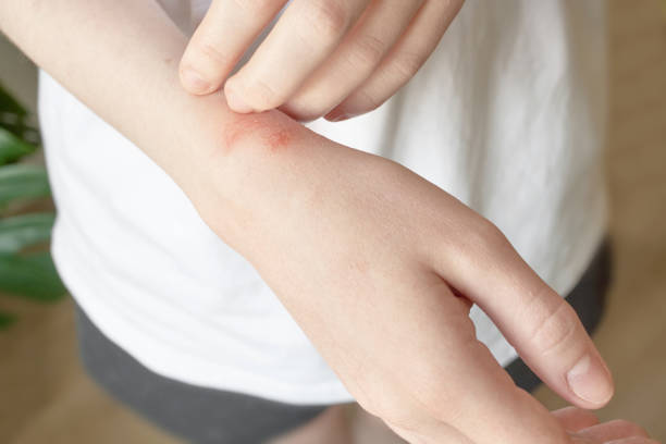 How Eczema Treatment Helps Rebuild Skin Barrier ? by Enfieldabudhabi