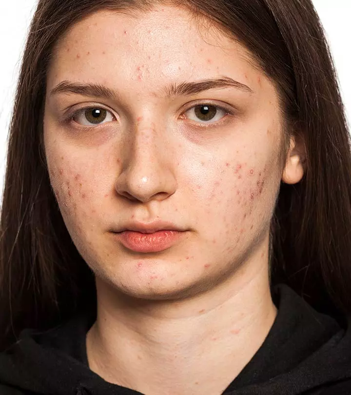 How Safe Is Acne Scar Laser Treatment Clinic Procedure? by aestheticclinicdubai6@gmail.com