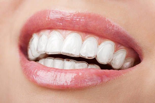 Your Path To A Straighter Smile Starts In Glendale With Invisalign Your Path To A Straighter Smile Starts In Glendale With Invisalign by GO Orthodontics Pasadena