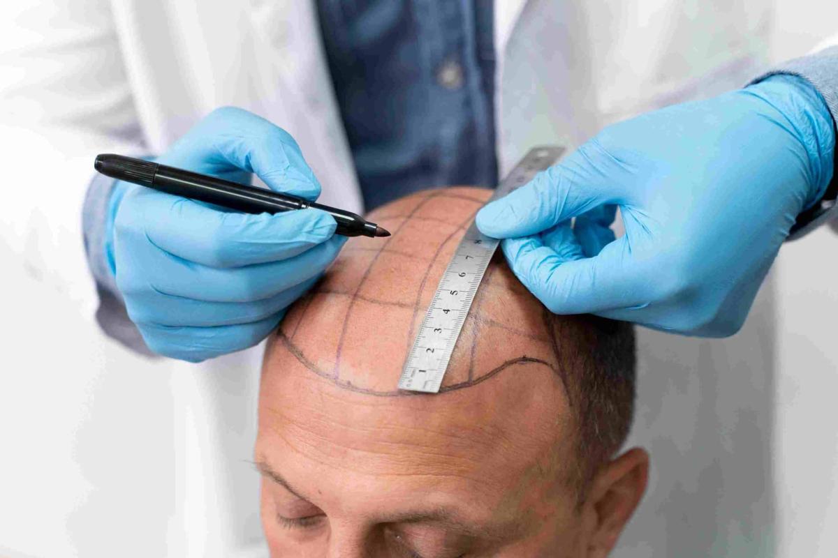 Say Goodbye To Bald Spots With Scalp Micropigmentation Dubai Say Goodbye To Bald Spots With Scalp Micropigmentation Dubai by aestheticclinicdubai6@gmail.com
