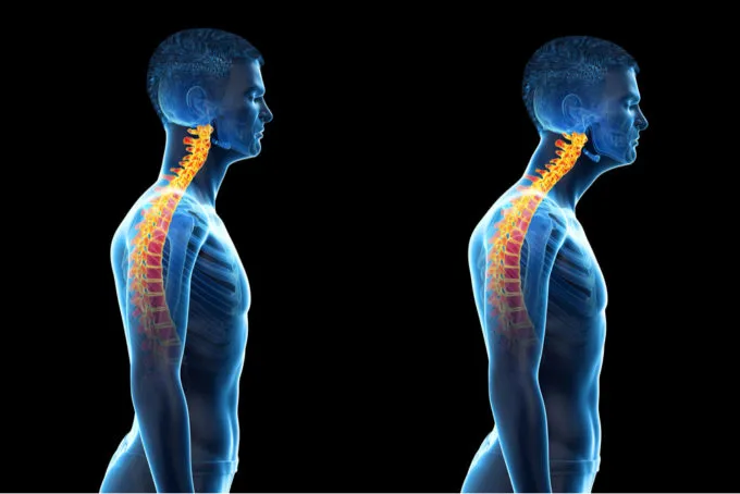 Forward head posture