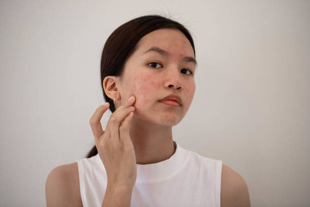 Is Acne Treatment Safe For Sensitive Skin Types? by Enfieldabudhabi