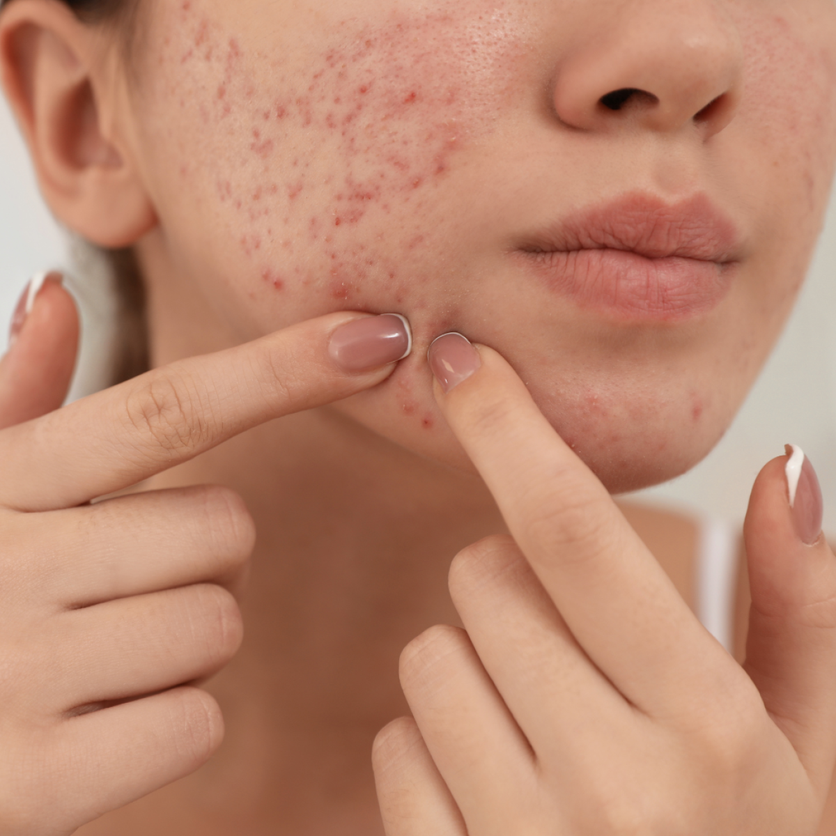 Is Laser Acne Scar Treatment Safe For Sensitive Skin? Is Laser Acne Scar Treatment Safe For Sensitive Skin? by MuhammadAhmad