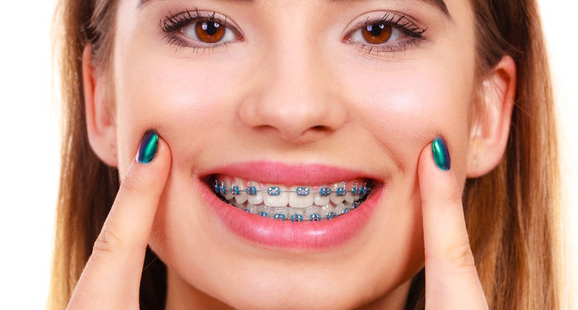 Are Braces Worth It For Mild Crooked Teeth? by glamorous