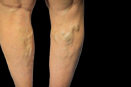 What Type Of Doctor Treats Vein Problems? by freddydecker