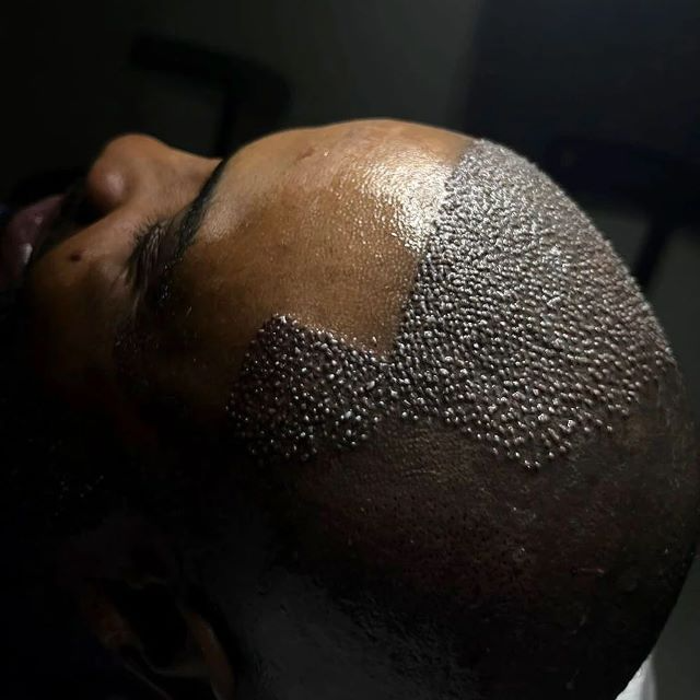 Can Turkey Really Fix Afro Hair Loss? Here’s The Truth by canton shopping guide