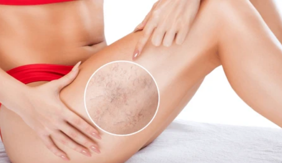 How Many Sessions Of Sclerotherapy Are Needed? by Enfieldabudhabi