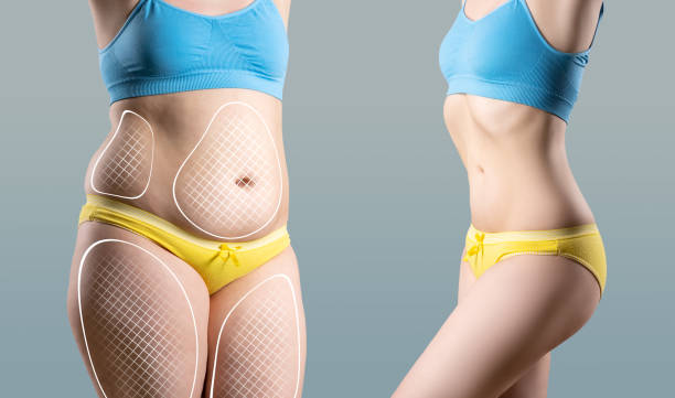 Why Riyadh Is Becoming A Hub For Liposuction Procedures by momin7
