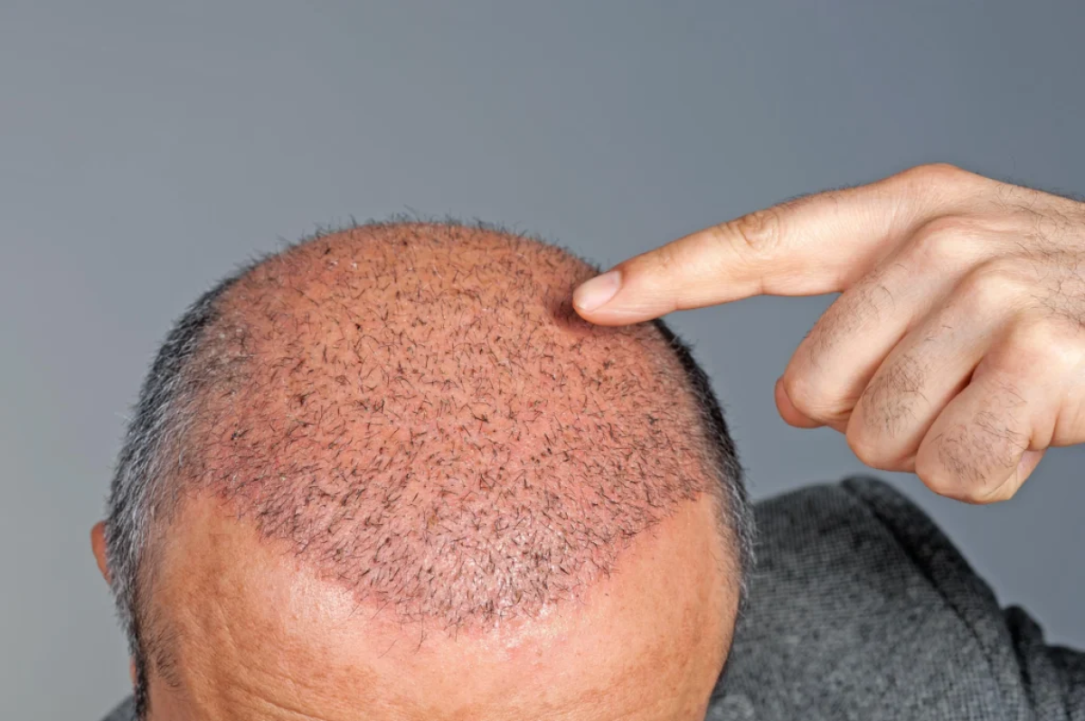 Is A Crown Hair Transplant A Recognized Medical Treatment? by Bisma jamal