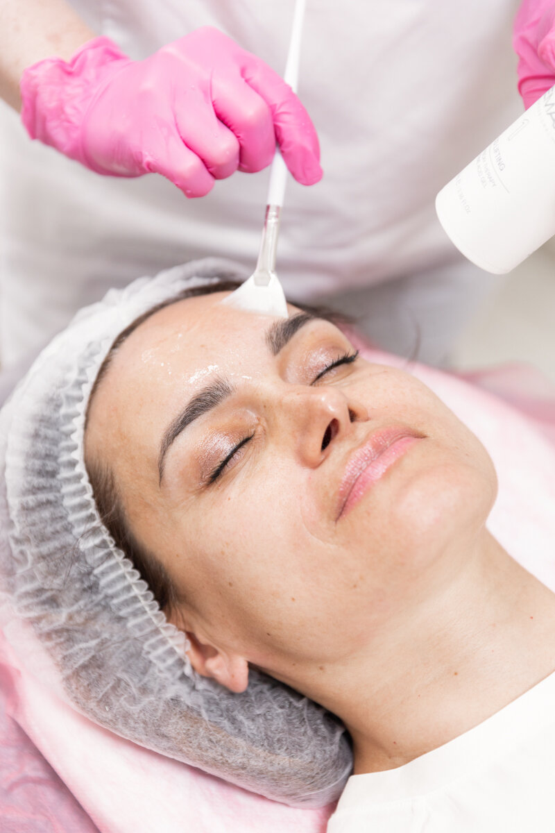 What Makes Cosmelan Peel Treatment Ideal For Dark Spots? by Dynamic Life Clinics