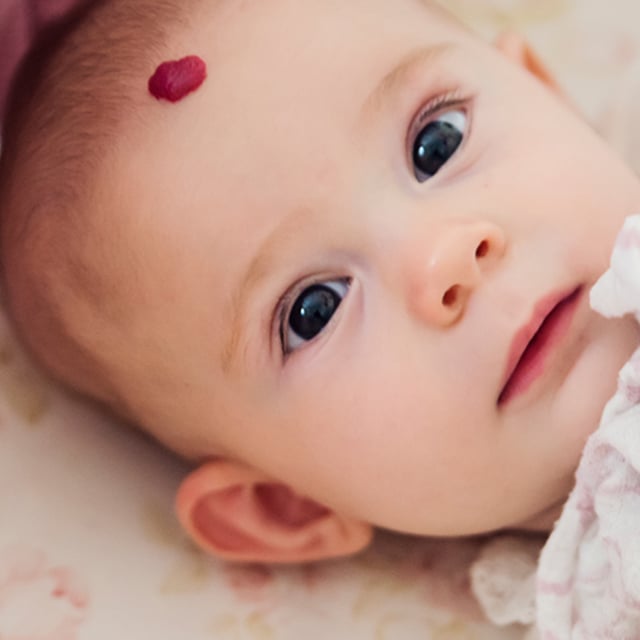 What Should You Know Before Considering Birthmark Removal? What Should You Know Before Considering Birthmark Removal? by MuhammadAhmad