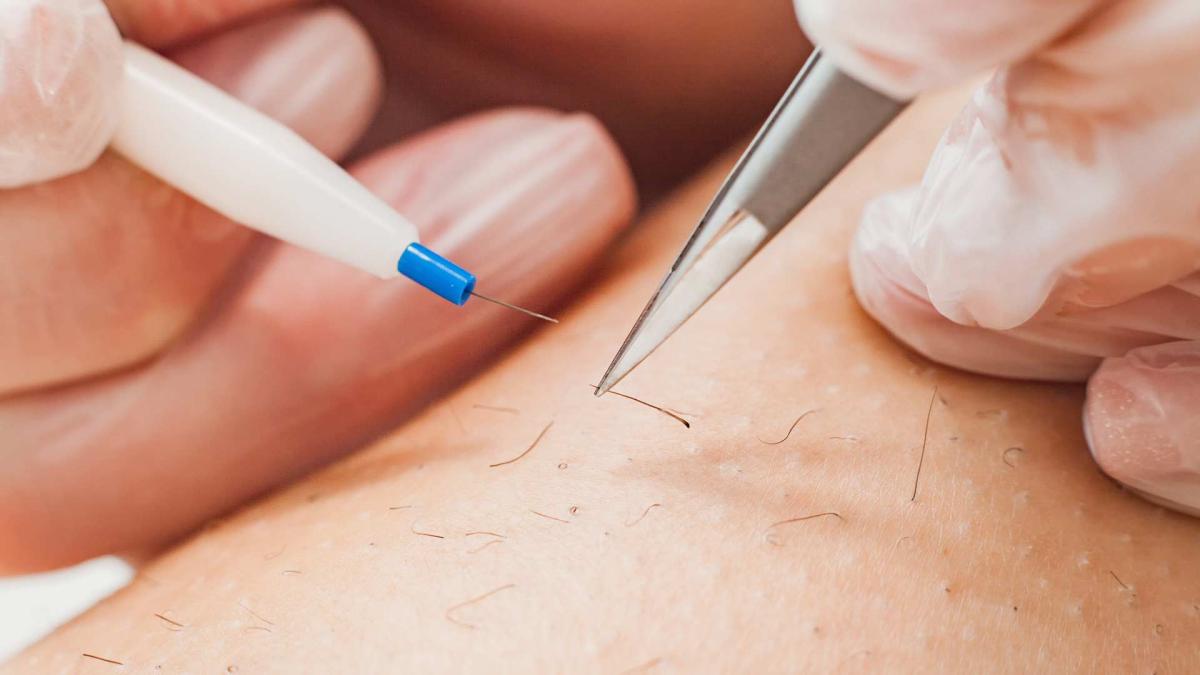 Can Electrolysis Safely Treat Ingrown Hair? by fatimadynamic
