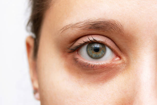Is Blepharoplasty Effective For Under-Eye Bags? by Enfieldabudhabi