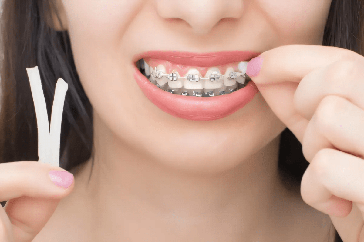 6 Tips On Caring For Metal Braces For Teenagers & Young Adults 6 Tips On Caring For Metal Braces For Teenagers & Young Adults by Lashay Deloach