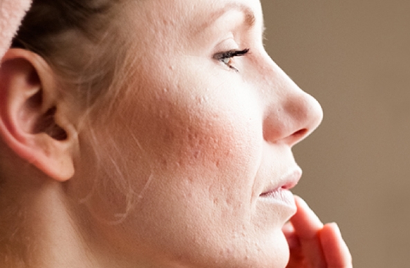 Is Acne Scar Treatment Suitable For Sensitive Skin? Is Acne Scar Treatment Suitable For Sensitive Skin? by MuhammadAhmad