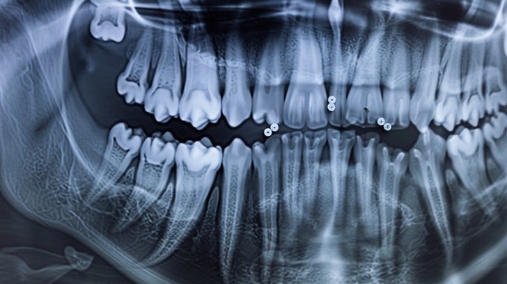 Is Panoramic Dental X-ray Safe? by Aesthethic Clinic
