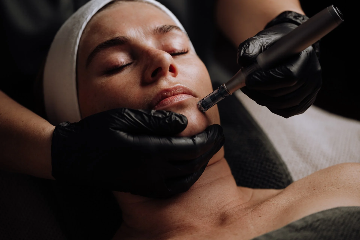 How Is Microneedling Performed For Optimal Skin Renewal? by eirhakhan