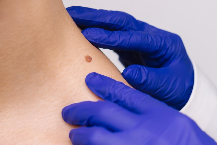 Does Warts Removal Hurt? What To Know Does Warts Removal Hurt? What To Know by eirhakhan