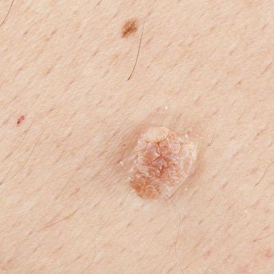 Does Skin Tag Removal Require Multiple Sessions? by dynamicaesthetic