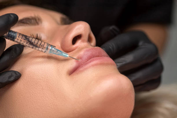 How Lip Fillers Can Help Smooth Out Lip Wrinkles ? by Enfieldabudhabi